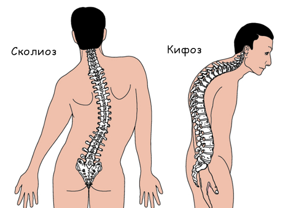 кифоз